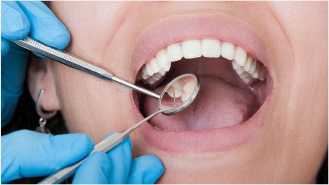 Этапы лечения пульпита зуба