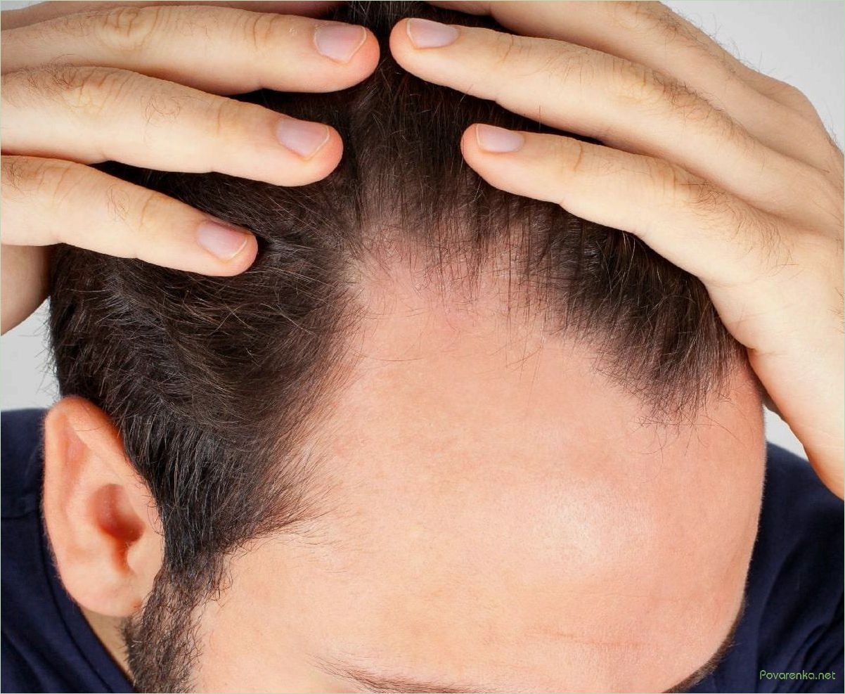 Все, что вы хотели знать об пересадке волос: современные методы и процедура