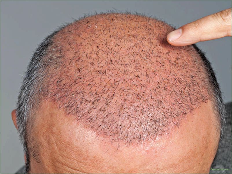 Все, что вы хотели знать об пересадке волос: современные методы и процедура