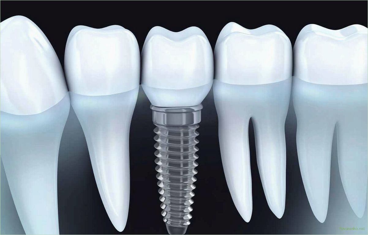 Имплант лайн. Зубной имплант Альфа био. Имплант Nobel. Имплантаты Astra Tech.