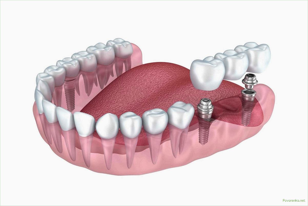 Имплантация зубов: цена, преимущества, процедура