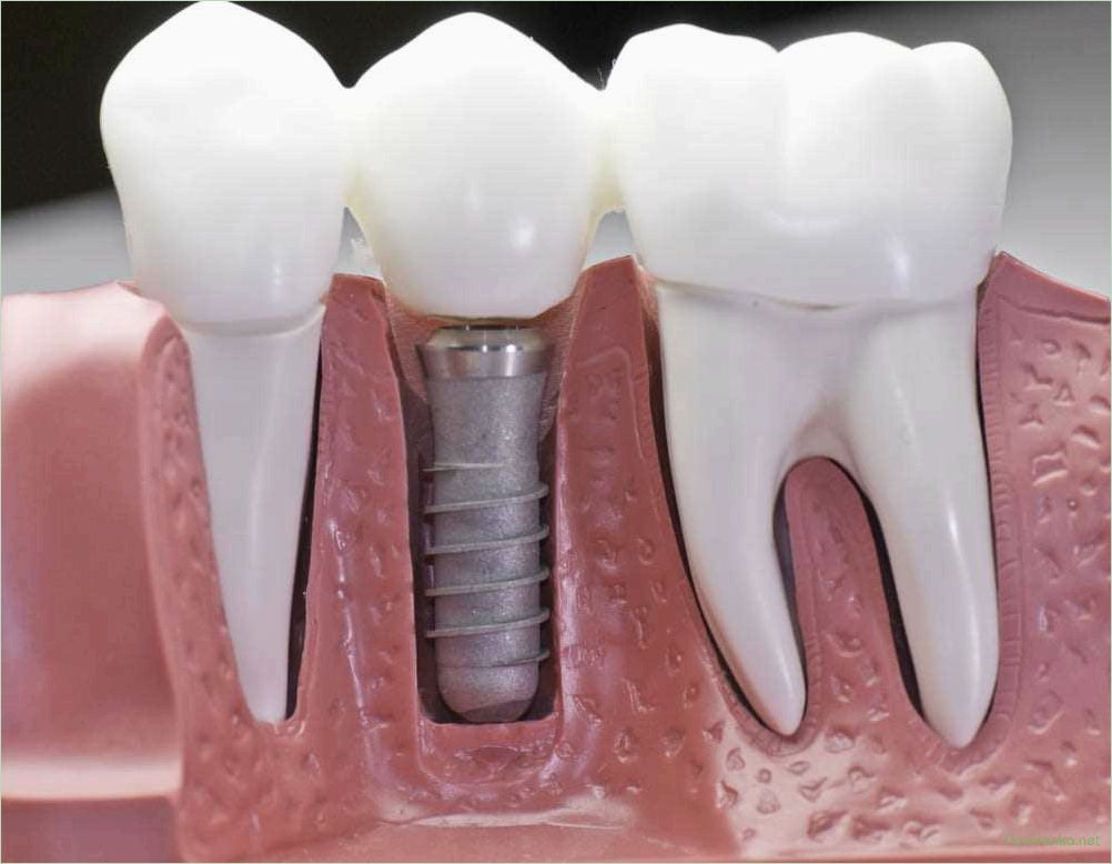 Имплантация зубов: цена, преимущества, процедура