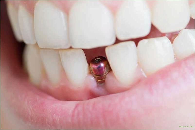 Имплантация зубов: все, что вам нужно знать