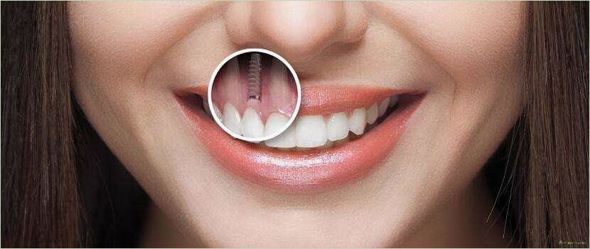 Имплантация зубов: все, что вам нужно знать